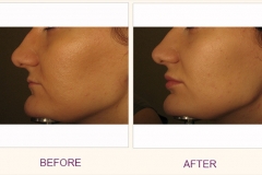 Lip Volumizing