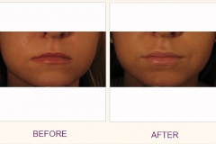 Lip plumping Juvederm