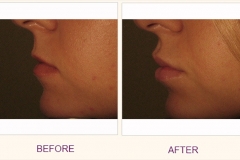 Lip augmentation Restylane