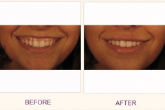 Lip improvement Perlane
