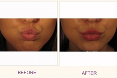 Lip augmentation Perlane