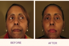 Make over WITH IPL, BOTOX AND RADIESSE/CHEEKS