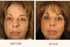 Make over WITH IPL, BOTOX AND RADIESSE/CHEEKS