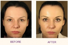 Make over WITH IPL, BOTOX AND RADIESSE/CHEEKS
