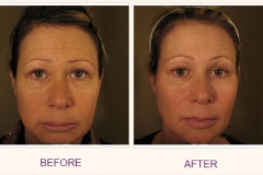 Make over WITH IPL, BOTOX AND RADIESSE/CHEEKS