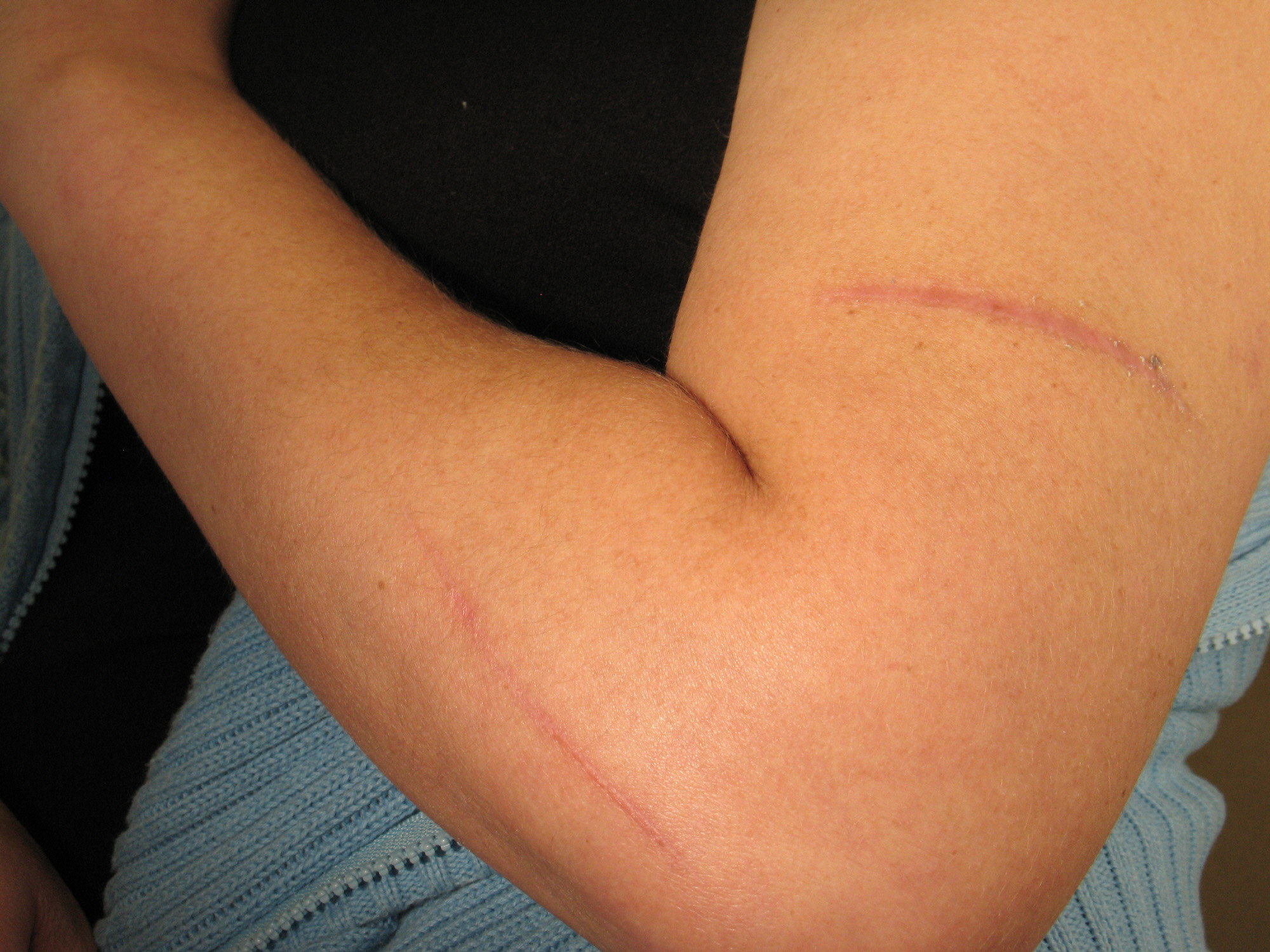 Before Scar Treatment.