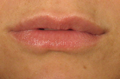 After Juvederm Treatment.