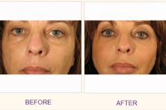Radiesse lip enhancement
