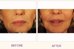 Restore Collagen with Sculptra