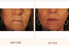 Restore Collagen with Sculptra