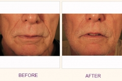 Restore Collagen with Sculptra