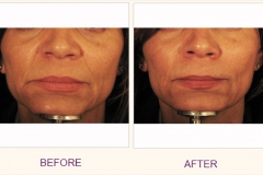 Restore Collagen with Sculptra