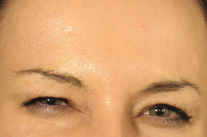 After Botox Treatment